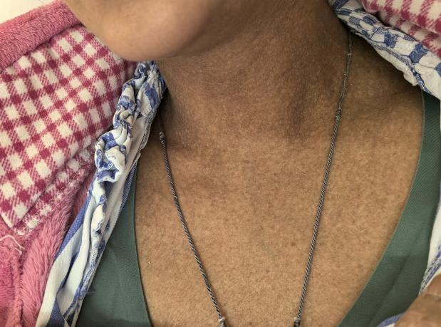 35 岁年轻妈妈突然浑身发黑，竟是因为这个  第2张