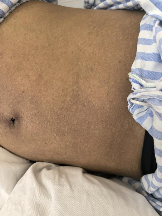 35 岁年轻妈妈突然浑身发黑，竟是因为这个  第3张