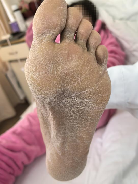 35 岁年轻妈妈突然浑身发黑，竟是因为这个  第6张