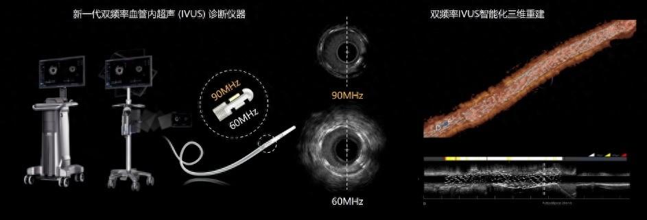 新一代超高频双频血管内超声成像诊断仪器，精准介入诊疗新突破  第1张