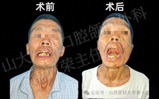 30 年张不开嘴，一朝手术重拾美食梦想！山医大一院口腔颌面外科团队再创奇迹  第1张
