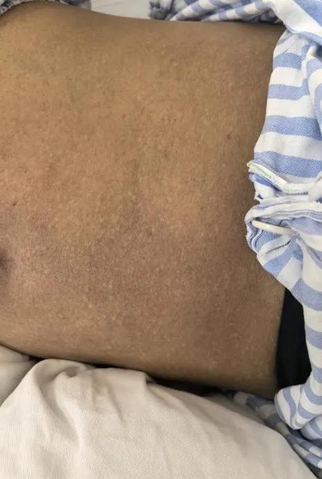 35 岁漂亮妈妈浑身发黑，竟然是因为这个  第2张