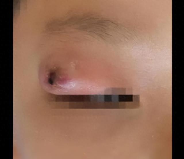 秋蚊猛如虎！孩子被叮后竟要手术切开清脓，家长们千万要注意