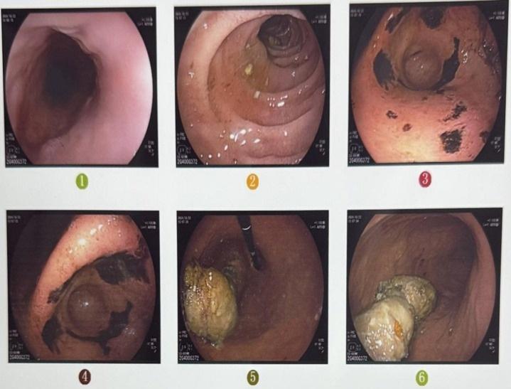 胃石症来袭！腹痛腹胀频发，深秋饮食不当的你中枪了吗？  第2张