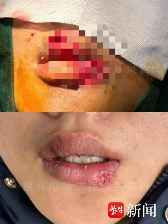 男子与宠物狗玩亲亲，嘴唇竟被咬掉