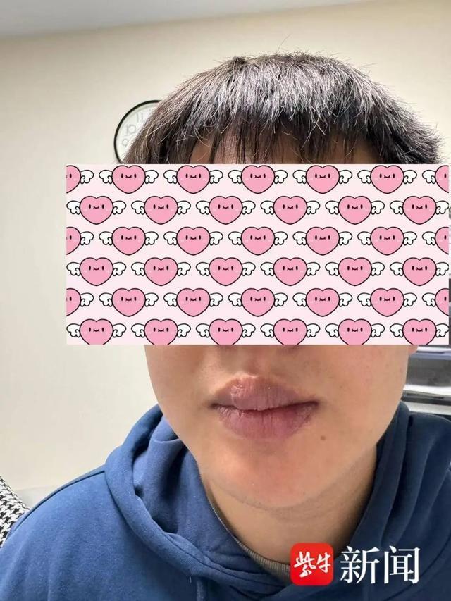 男子与宠物狗玩亲亲，嘴唇竟被咬掉  第2张