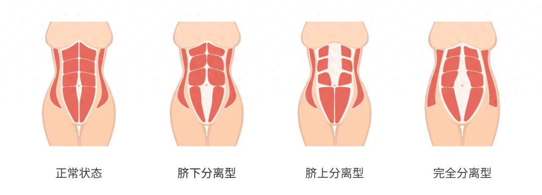 生娃后肚皮松垮皱巴像老了 10 岁？教你几招轻松恢复紧致小蛮腰  第1张