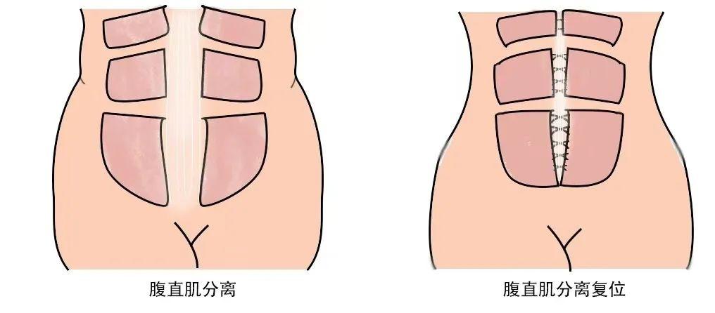 生娃后肚皮松垮皱巴像老了 10 岁？教你几招轻松恢复紧致小蛮腰  第2张