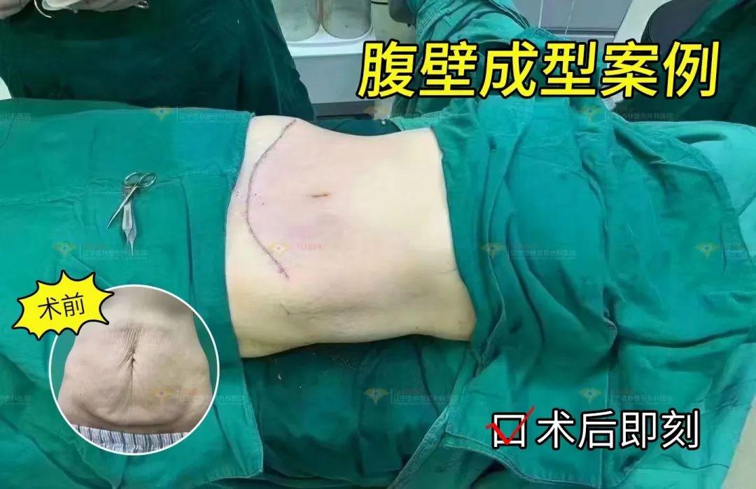 生娃后肚皮松垮皱巴像老了 10 岁？教你几招轻松恢复紧致小蛮腰  第3张