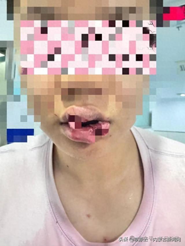 男子与宠物狗玩亲亲，竟被咬掉半个嘴唇