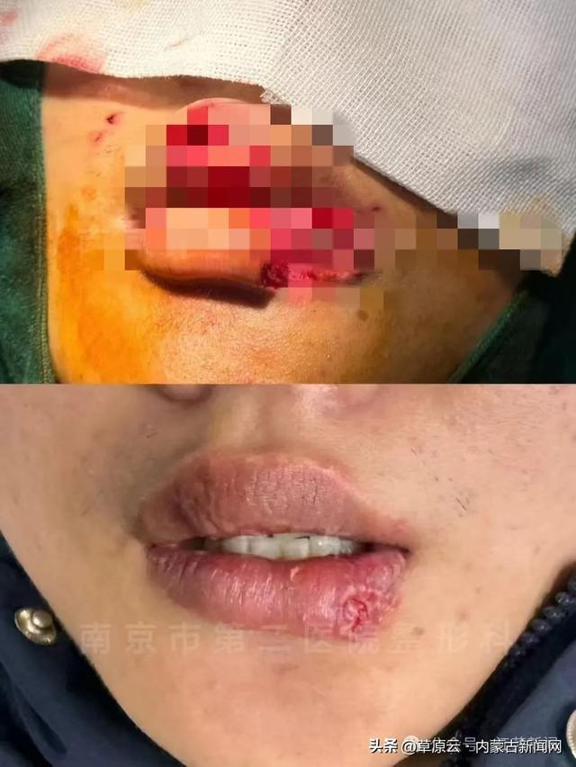 男子与宠物狗玩亲亲，竟被咬掉半个嘴唇  第3张
