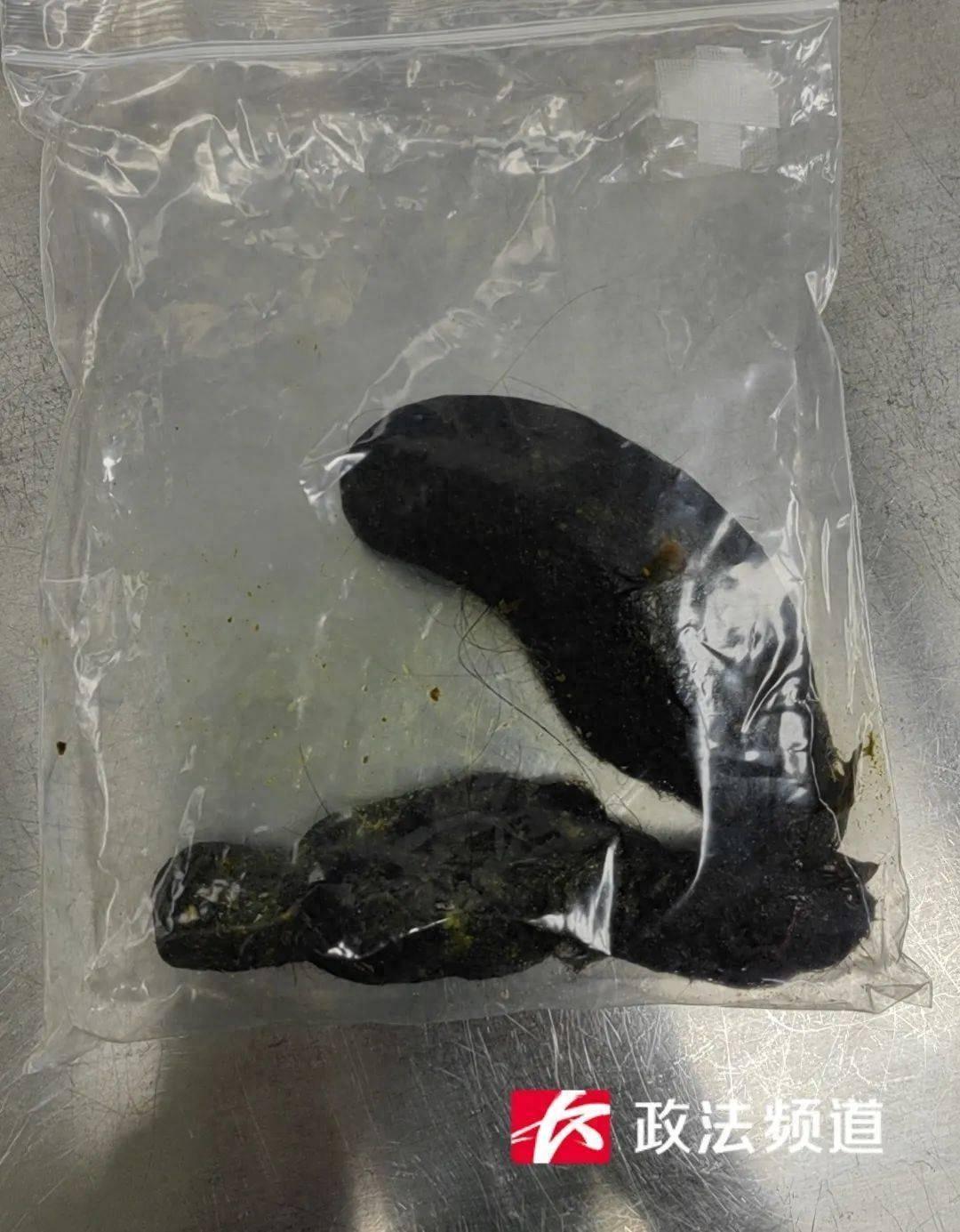 11 岁女孩腹痛难忍，医生手术取出胃内 12x15x10cm 头发团，咋回事？