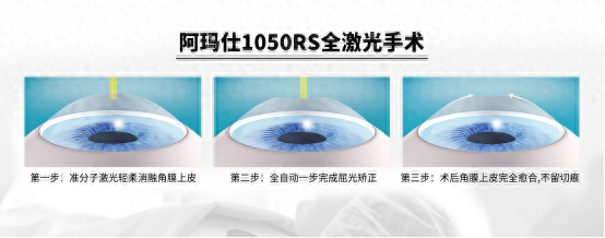 颠覆认知！非制瓣式眼科手术，不开刀不制瓣，轻松摘镜  第1张