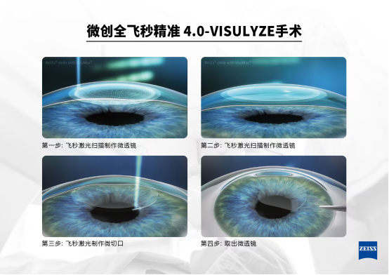 颠覆认知！非制瓣式眼科手术，不开刀不制瓣，轻松摘镜  第2张