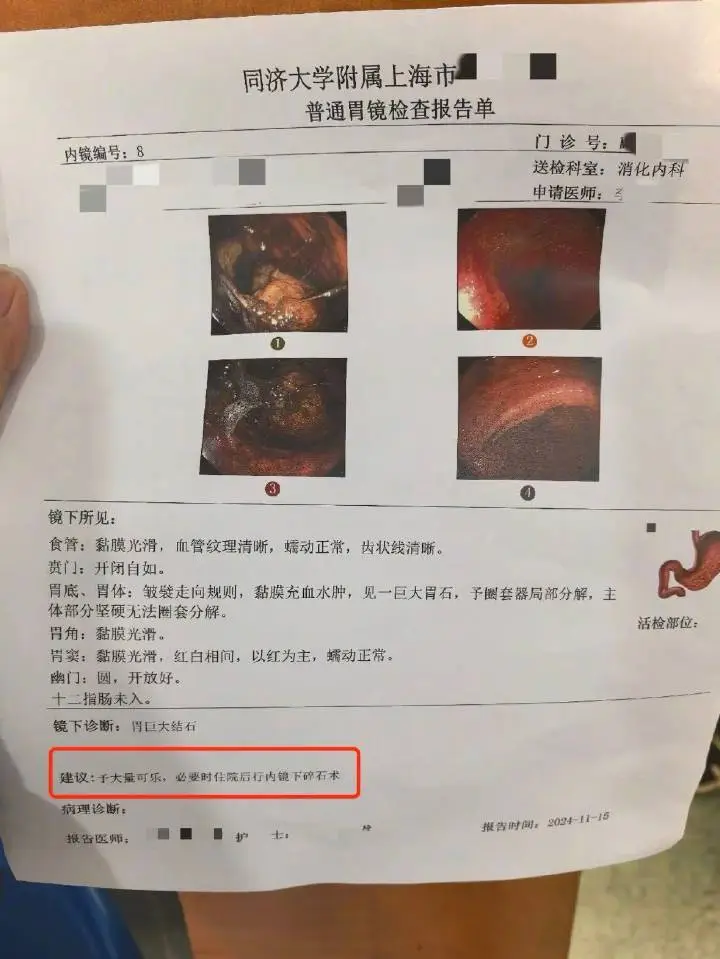 女子吃 30 多颗山楂后胃里长结石，喝可乐能化解？专家：有效但不能乱用  第3张
