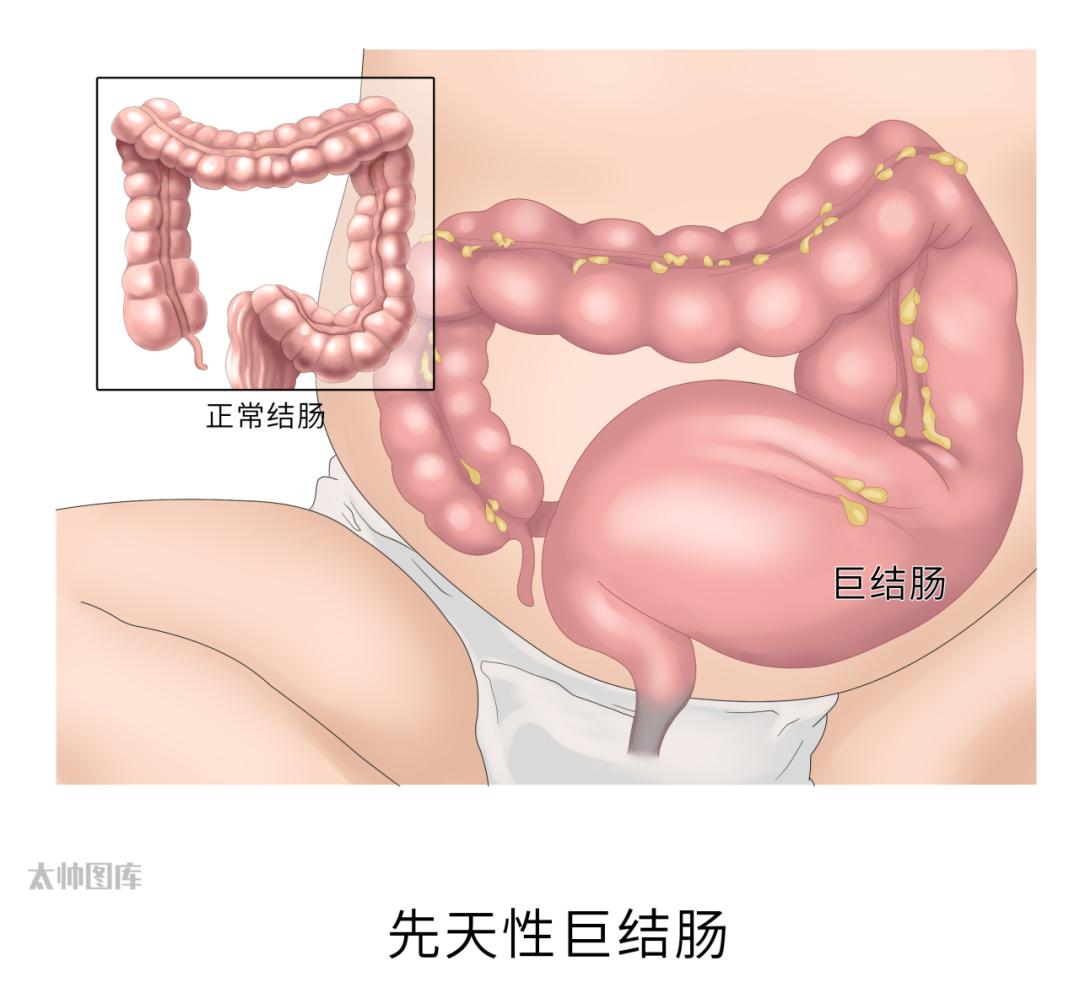 惊！女子腹中巨蟒盘踞，医生紧急手术救命，先天性巨结肠不可忽视  第4张