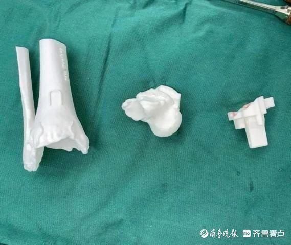 61岁老人因踝关节疼痛夜不能寐，3D打印技术带来新生，国内先进水平引爆关注  第2张