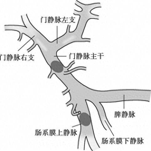 山东李先生肝硬化伴消化道出血，门静脉血栓成因竟然是……  第1张