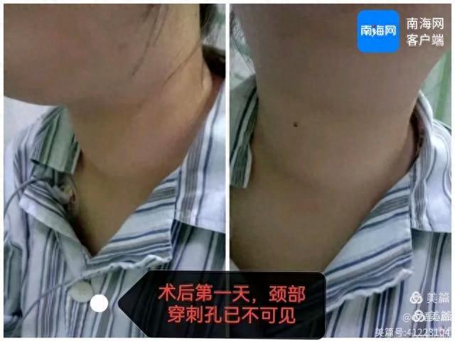20 分钟手术让患者自行走回病房，还不用终身服药