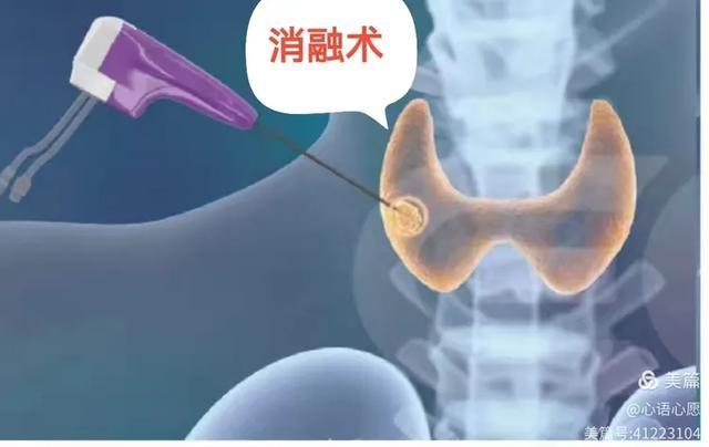 20 分钟手术让患者自行走回病房，还不用终身服药  第2张