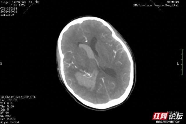 17 岁女孩国庆游长沙突发脑血管意外，特种兵式打卡旅行需谨慎  第1张