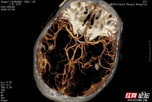 17 岁女孩国庆游长沙突发脑血管意外，特种兵式打卡旅行需谨慎  第2张