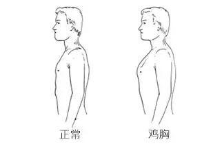 胸廓畸形危害大，早发现早干预！了解这些知识很重要  第2张