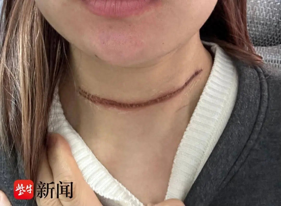 风筝线割喉！三天后伤口结疤明显，女子获赔 500 元后竟遭拒赔