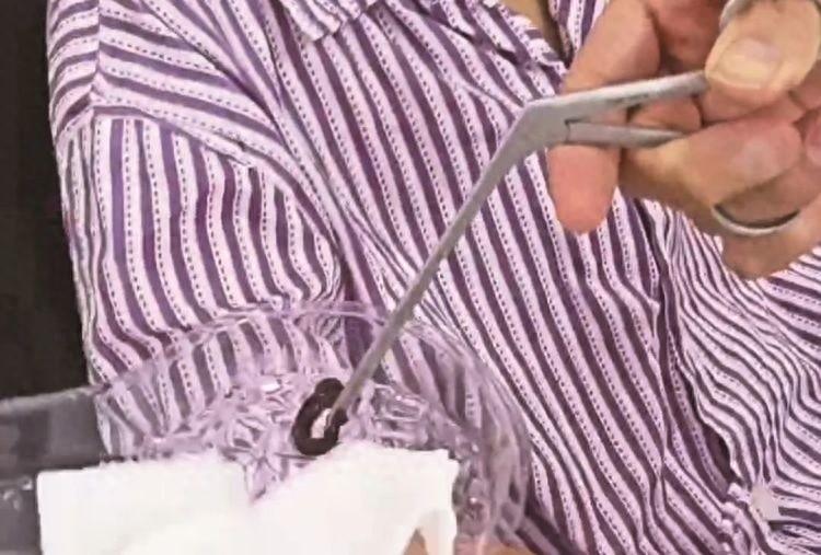 12 岁男孩鼻腔反复流血，罪魁祸首竟是它