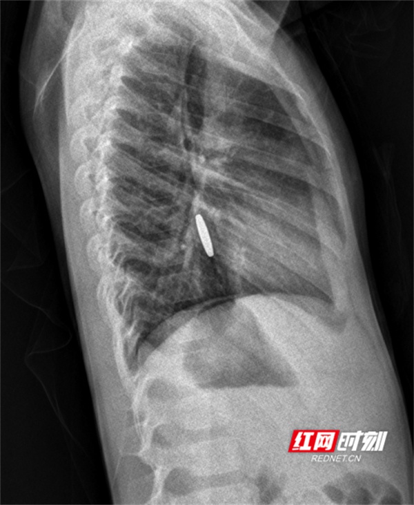 误吞异物怎么办？放射科神器X线CT帮你快速定位，但这些异物却无法被发现  第1张