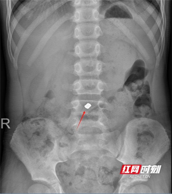 误吞异物怎么办？放射科神器X线CT帮你快速定位，但这些异物却无法被发现  第3张
