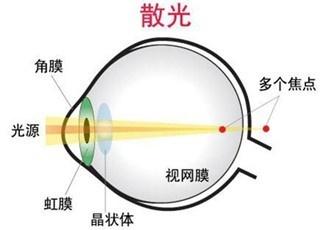 原来散光竟然是这么回事！你知道吗？  第1张