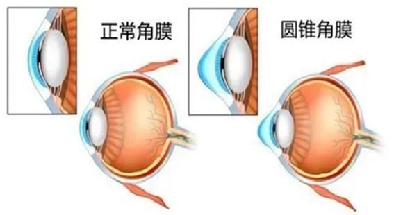 原来散光竟然是这么回事！你知道吗？  第2张