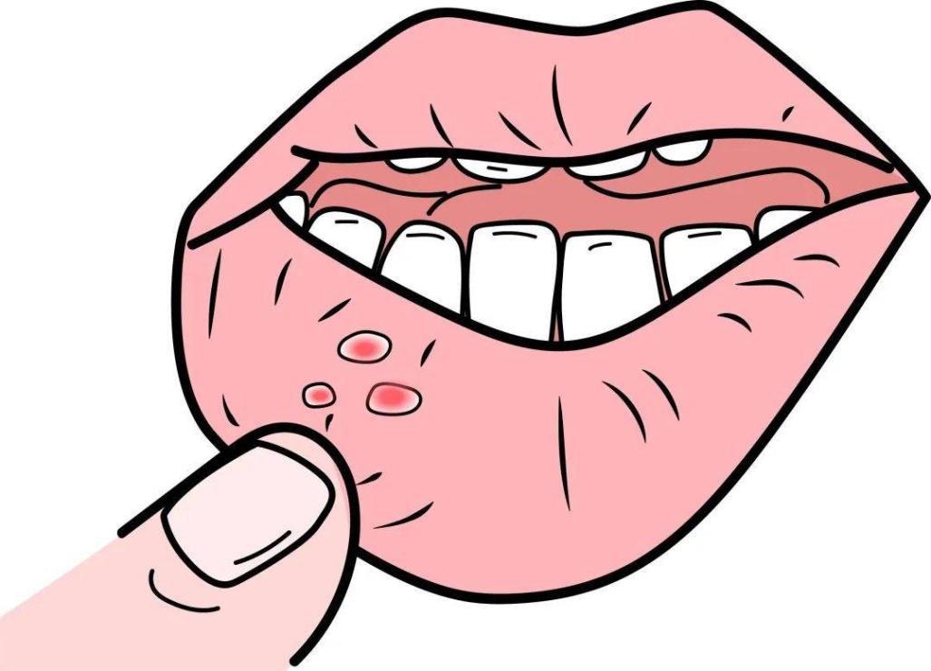 口腔有问题却不知病因？口腔黏膜活检来揭秘  第2张
