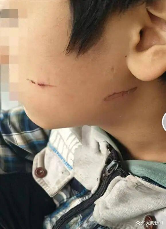 四川泸州中学生遭同学暴力伤害，二度烫伤真相曝光  第2张