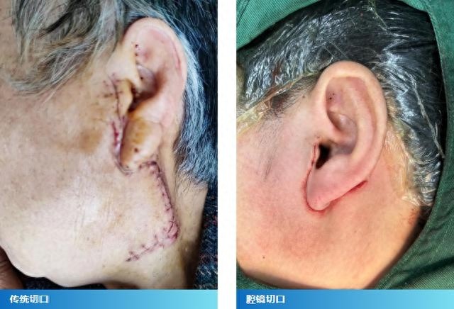 从S形到V形：滨州市人民医院创新腮腺肿瘤切除术，美丽与健康兼得
