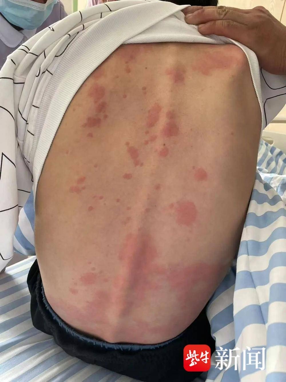 14岁豆豆突发罕见红斑，家长惊慌失措，专家揭秘渗出性多形性红斑真相  第2张