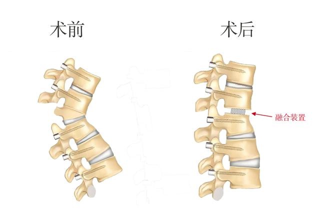70岁阿尔及利亚企业家腰椎手术成功，浙江省人民医院骨科团队再创奇迹  第2张