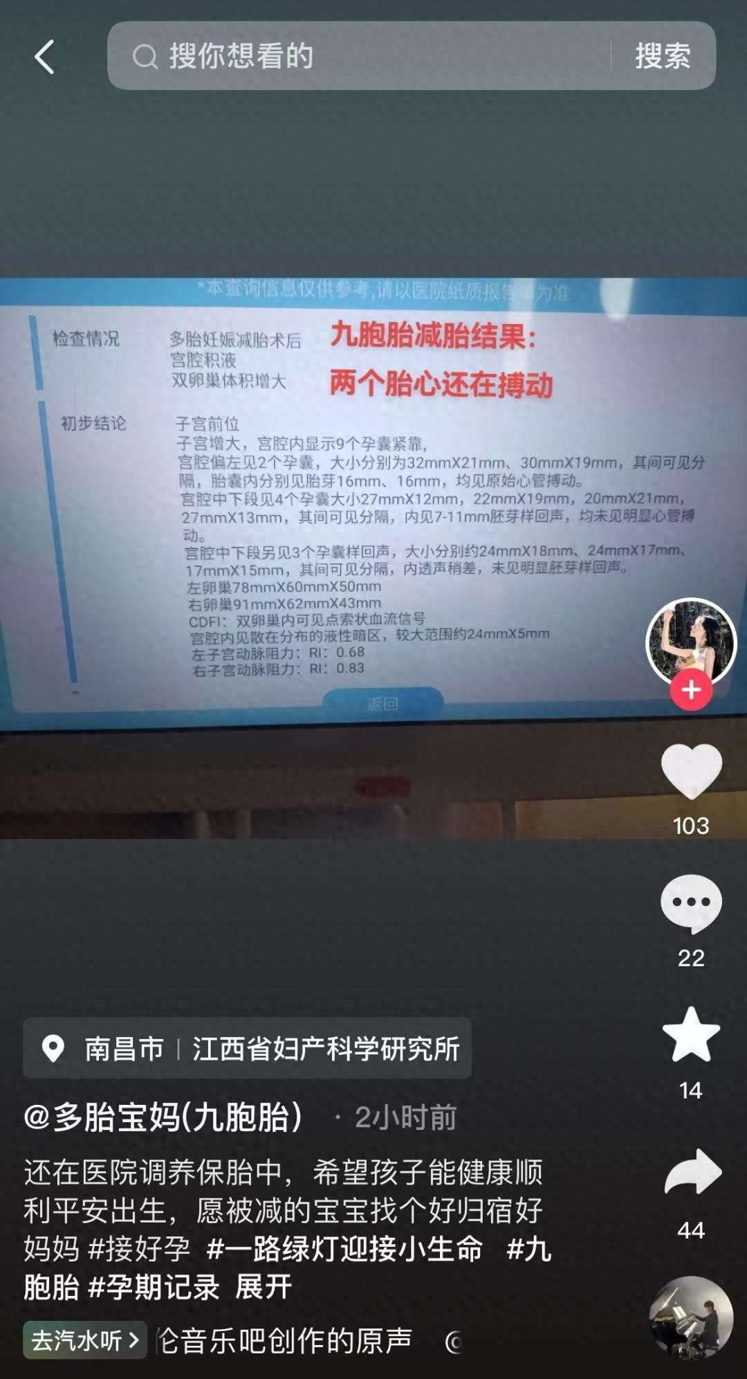 25岁女子怀9胞胎，减胎后仍存2胎心搏动，奇迹能否延续？