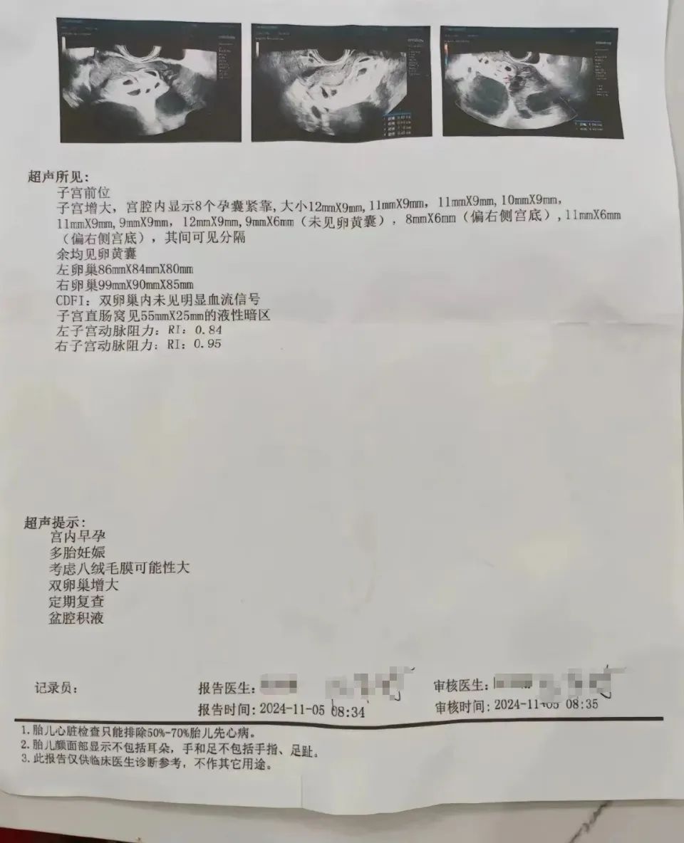 25岁女子怀9胞胎，减胎后仍存2胎心搏动，奇迹能否延续？  第2张
