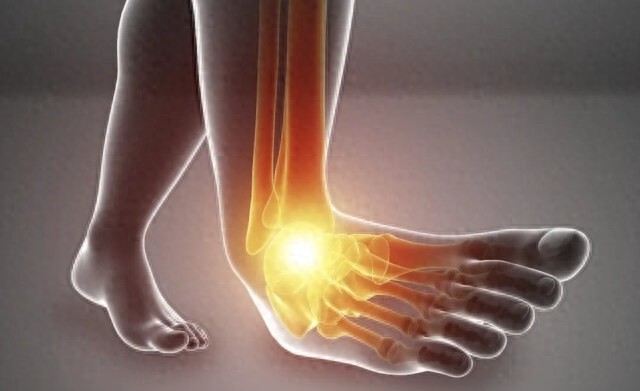 崴脚后症状缓解就大意?两人不重视终住院,警惕 第1张 崴脚后症状缓解就大意?两人不重视终住院,警惕 第1张