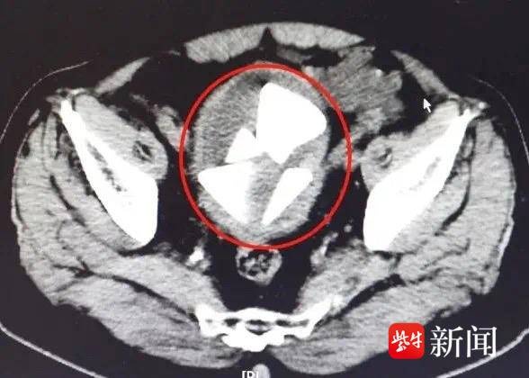 78岁老人膀胱惊现金字塔结石，医生首次取出，泌尿外科主任揭秘罕见病例  第2张
