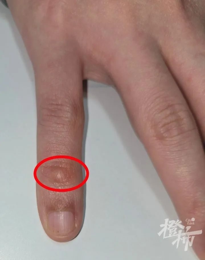 手指上的小包竟是疣？医生揭秘真相，结果让人意想不到  第2张