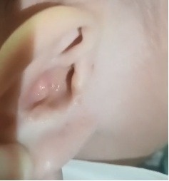 1岁半宝宝棉签掏耳竟致脑脊液漏！医生紧急提醒：家长需警惕这一危险行为  第1张