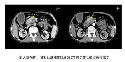 62 岁熊猫血患者命悬一线，哈医大一院成功救治