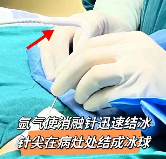 成都中医哮喘医院引入先进技术，成功帮助肺结节患者找回生活希望  第2张