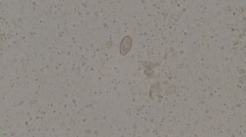 揭秘！生鱼片里的致命威胁：一家三口因肝吸虫病险些丧命  第2张