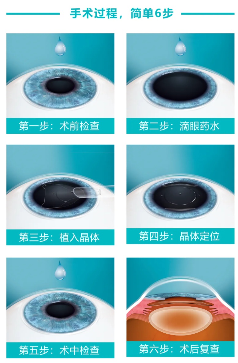 揭秘ICL晶体植入手术：从准备到术后，这份保姆级攻略让你一目了然  第3张