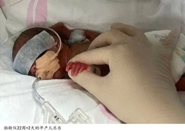 22周+2天，450克！上海最小早产儿乐乐如何战胜四大难关，创造生命奇迹？  第1张