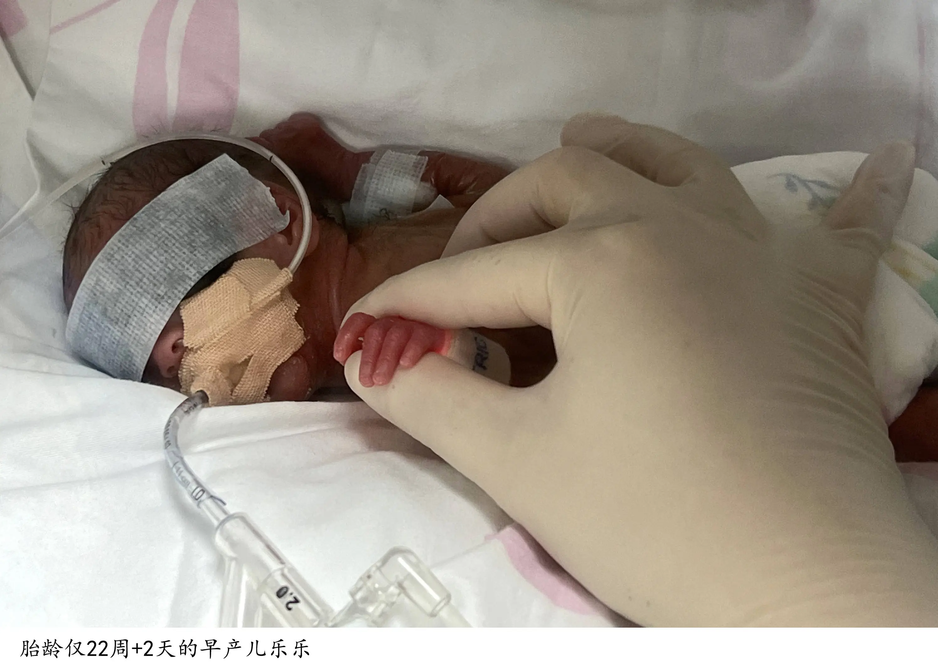 奇迹！胎龄仅22周+2天、体重450克的超早产儿成功出院，刷新上海纪录  第1张